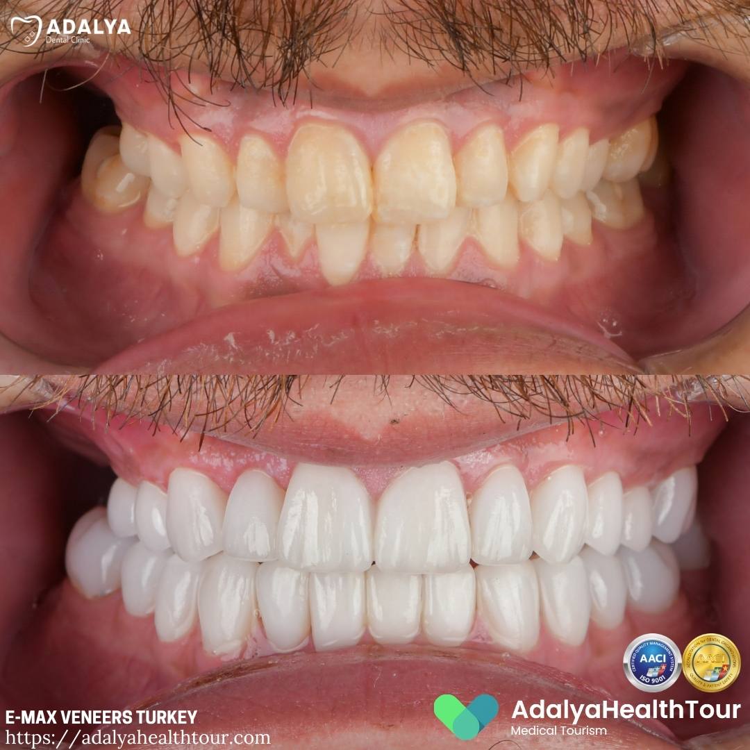 turkey tooth before after
