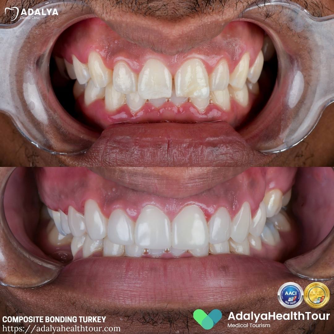 turkey tooth bonding before after