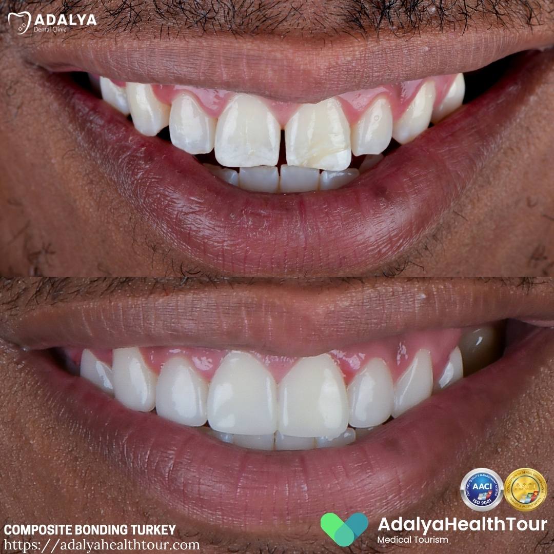 turkey tooth bonding before and after