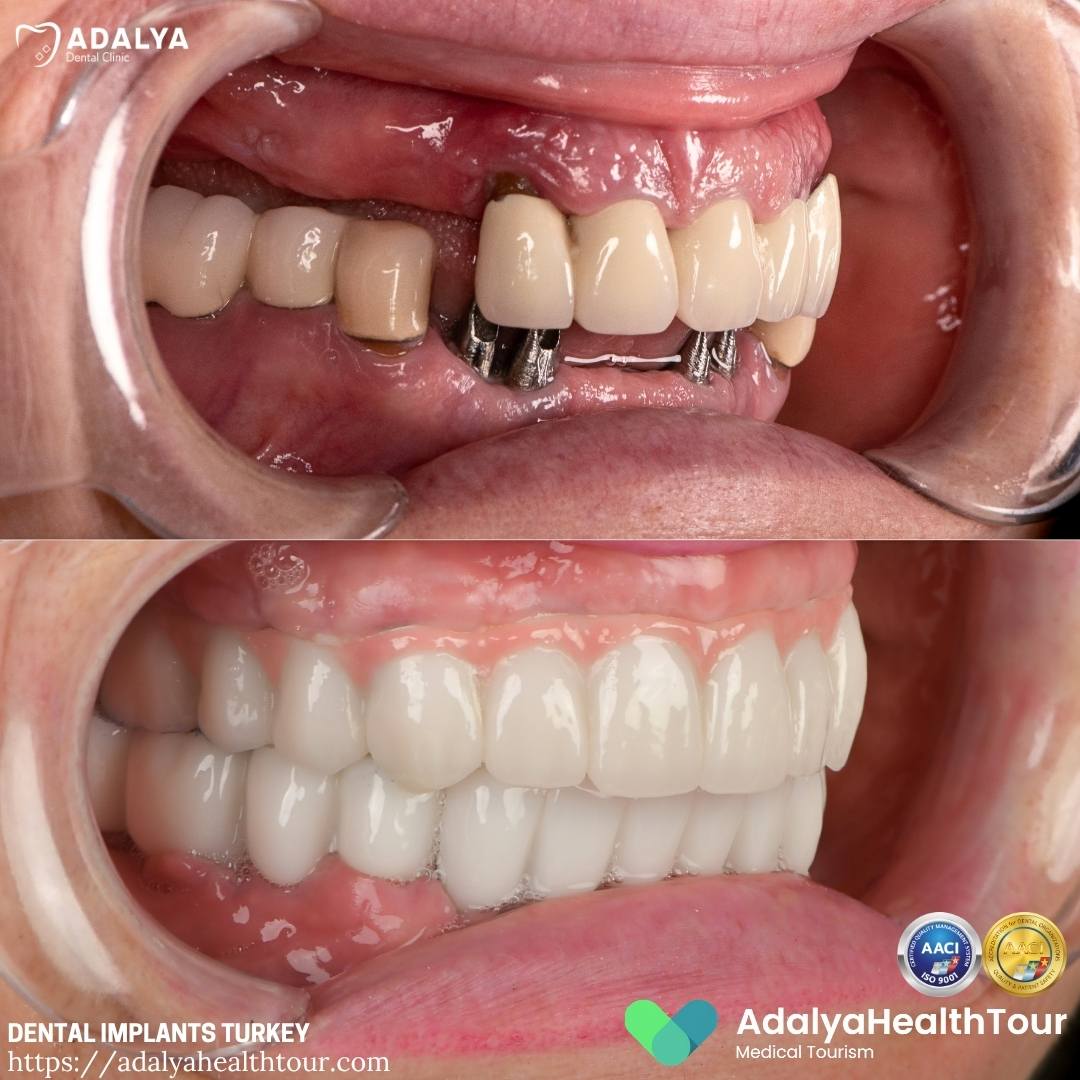 turkey tooth implants before after