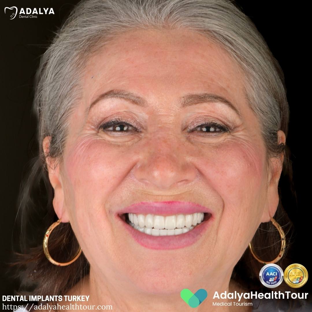 turkey tooth implants before and after american patient