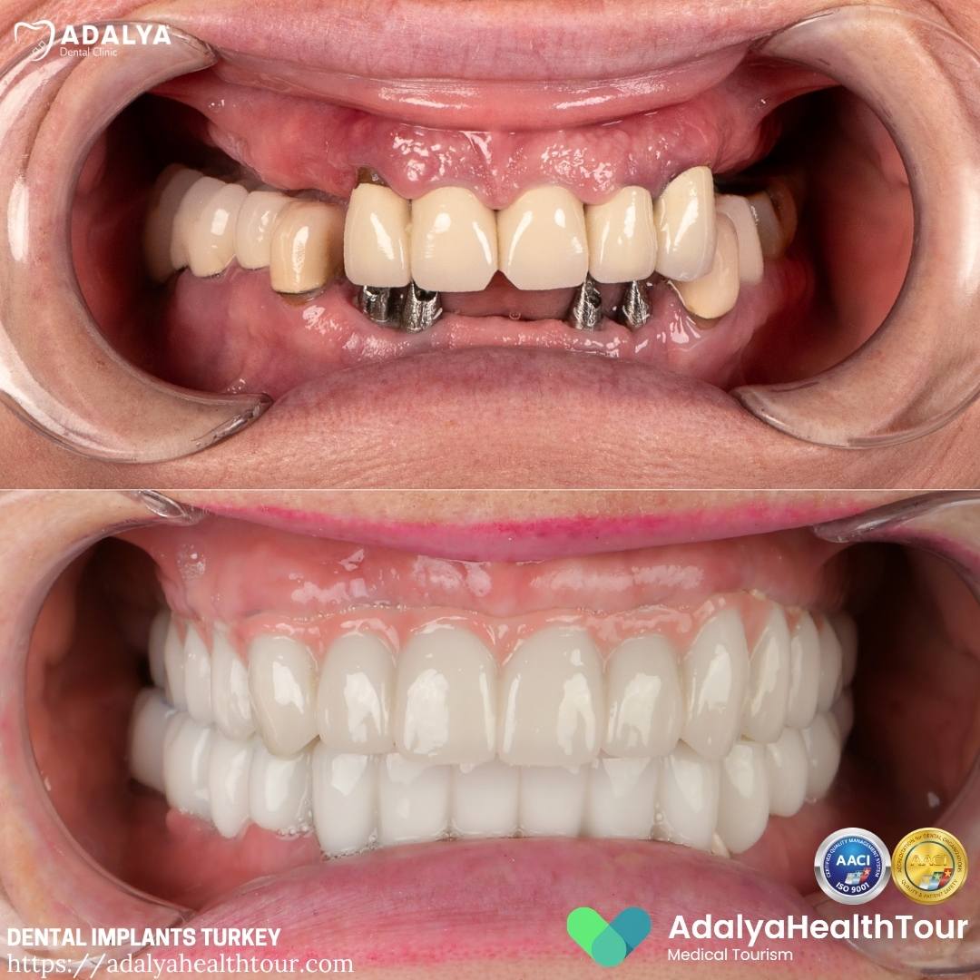 turkey tooth implants before and after