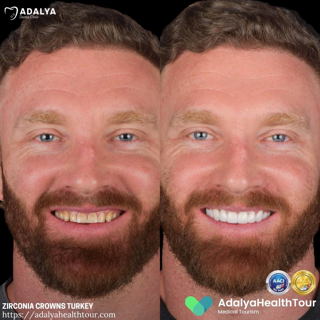 zirconium crowns turkey before after uk patient