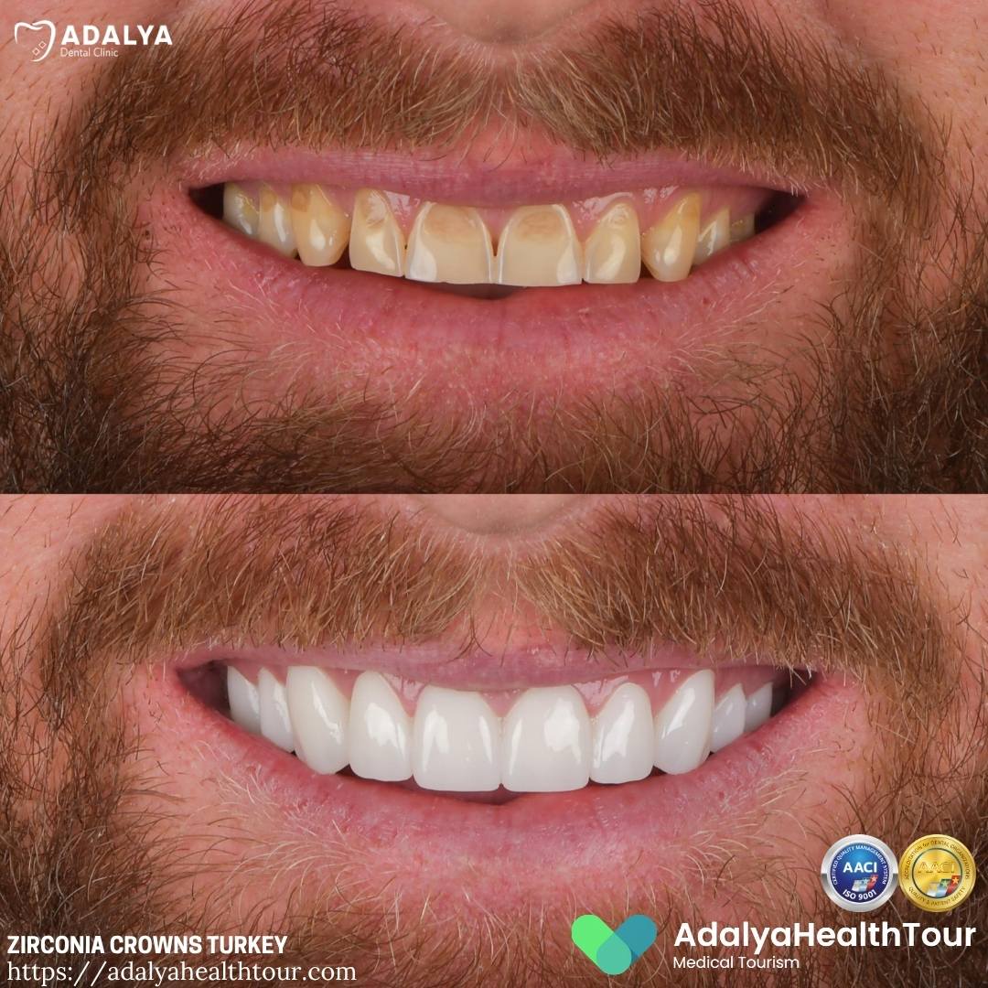 zirconium crowns turkey before after