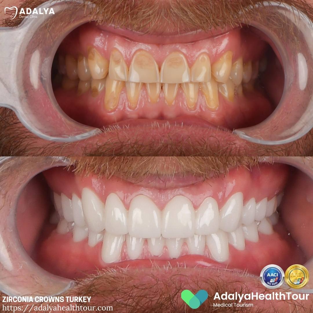 zirconium crowns turkey before and after